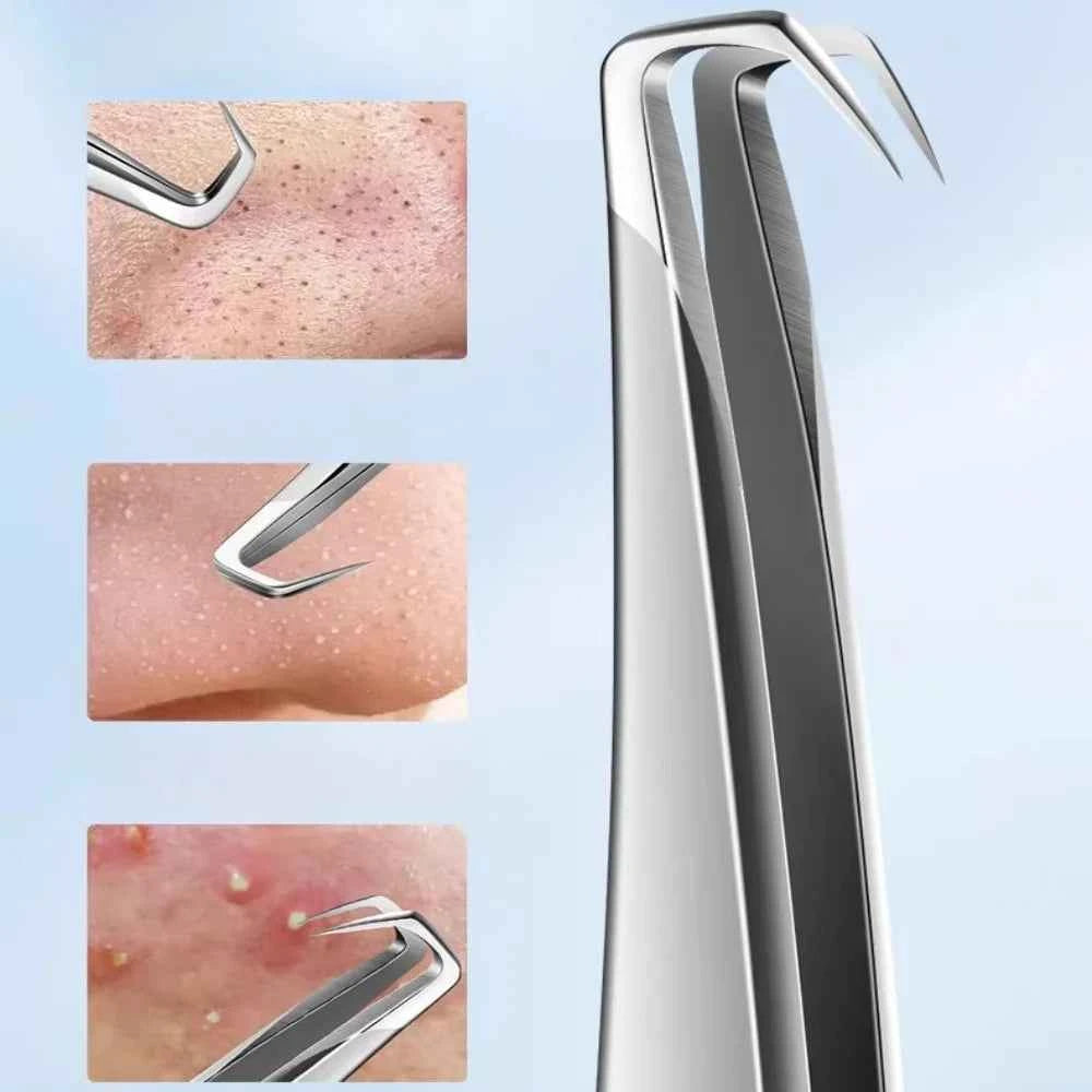 High-Precision Blackhead Remover Tweezers Set – Professional Pimple Extractor & Hair Removal Tools for Flawless Skin