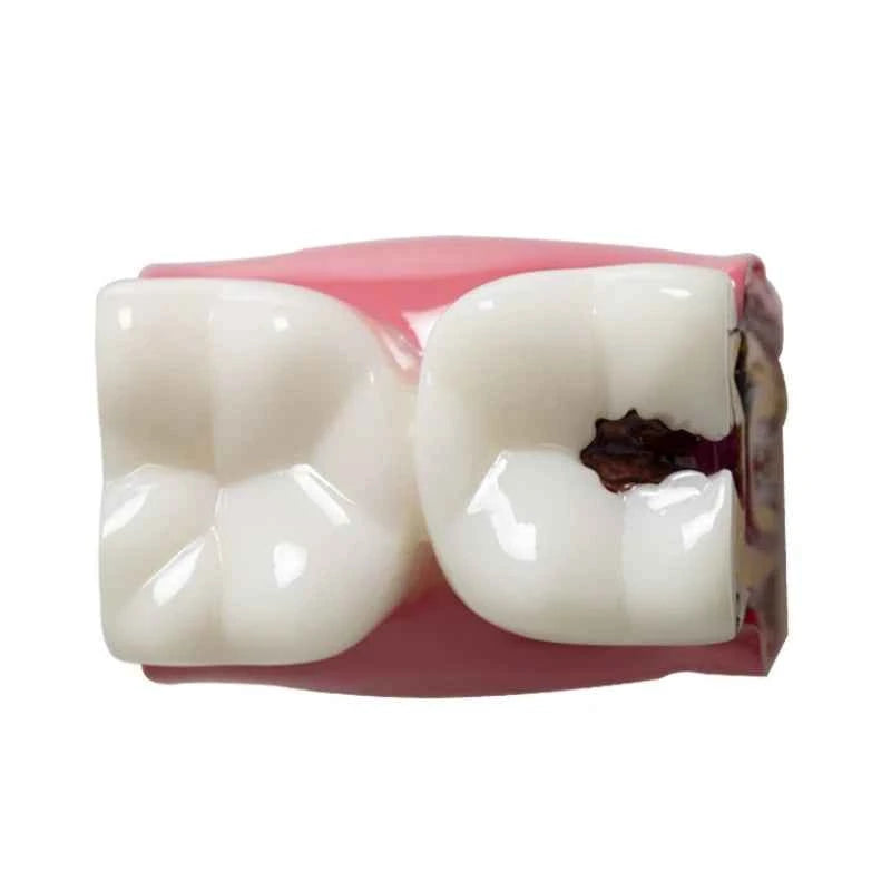 Dental Dynamics 6/8 Tooth Caries Comparison Model - Inspire Your Dentistry Skills with This Anatomical Teaching Tool!